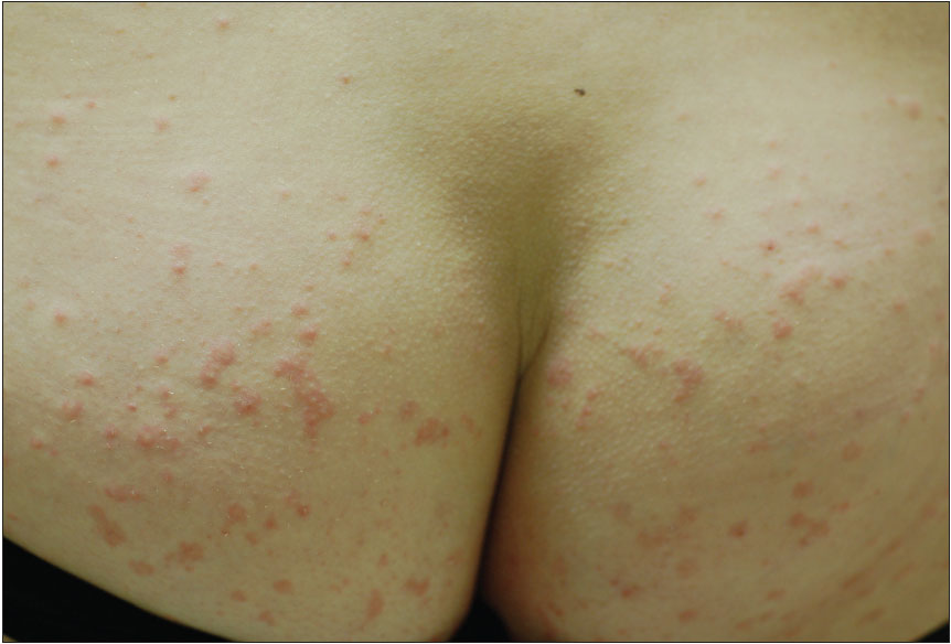 Keratosis Pilaris in Adults: Condition, Treatments, and ...