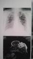 乳癌のレントゲン写真　乳癌の画像　肺の癌の画像　レントゲン 末期癌のレントゲン写真